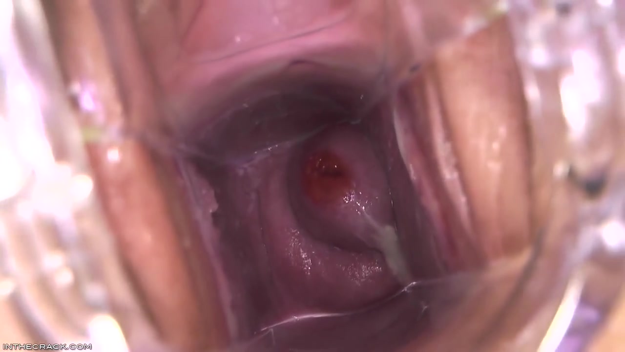 Cervix Cum Glob