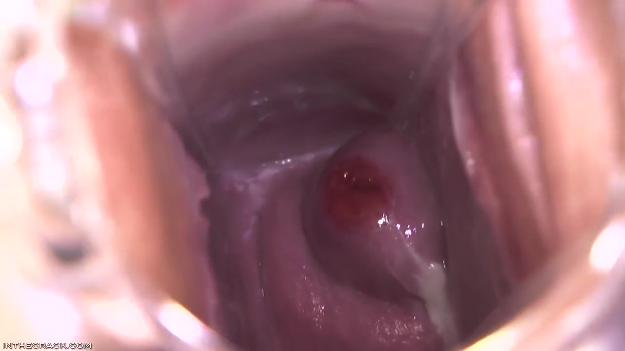 Cervix Cum Glob
