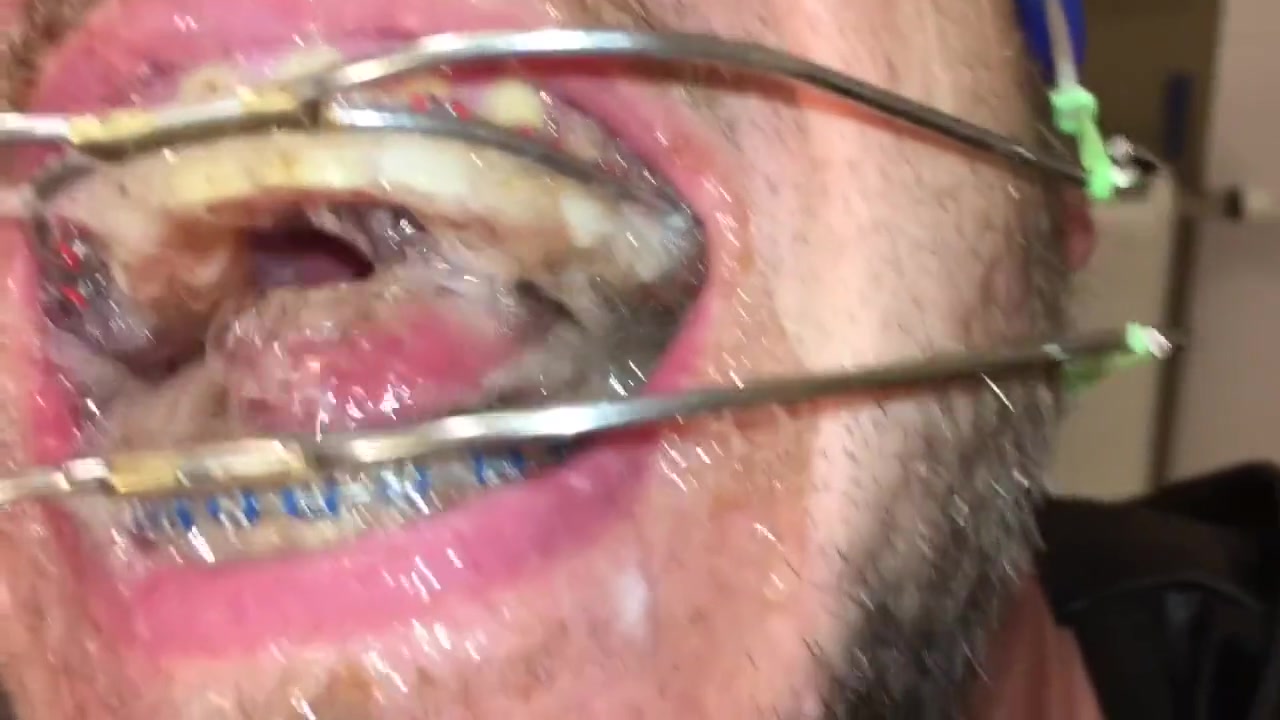 Horny Deepthroat Full Of Spit With Braces And Double Headgear