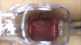 Anal fisting extreme and Speculum in ass