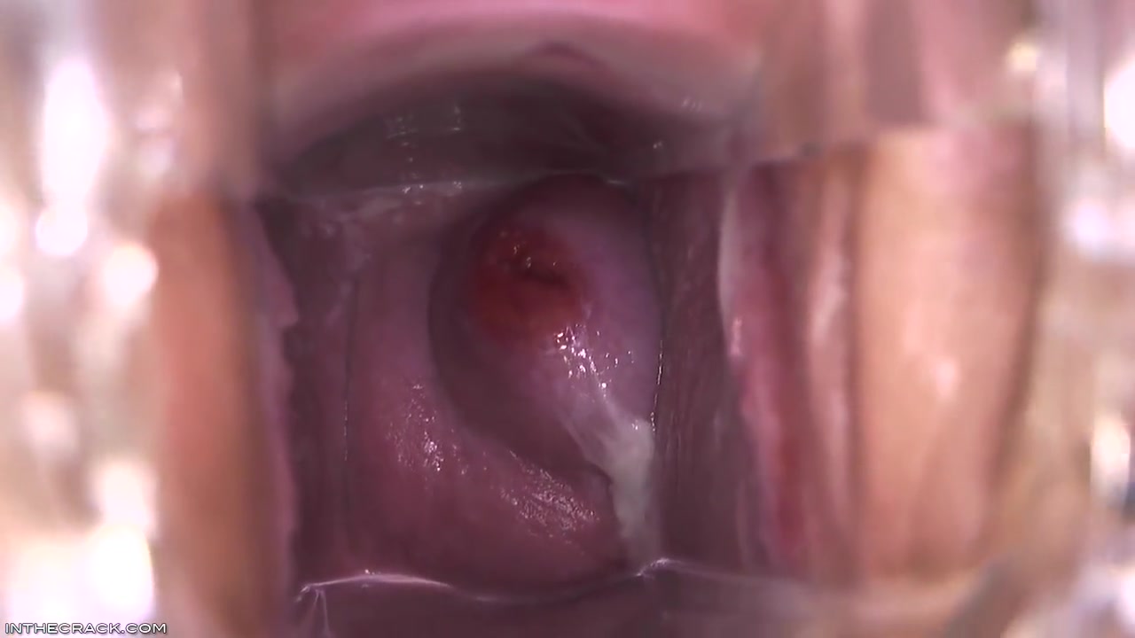 Cervix Cum Glob