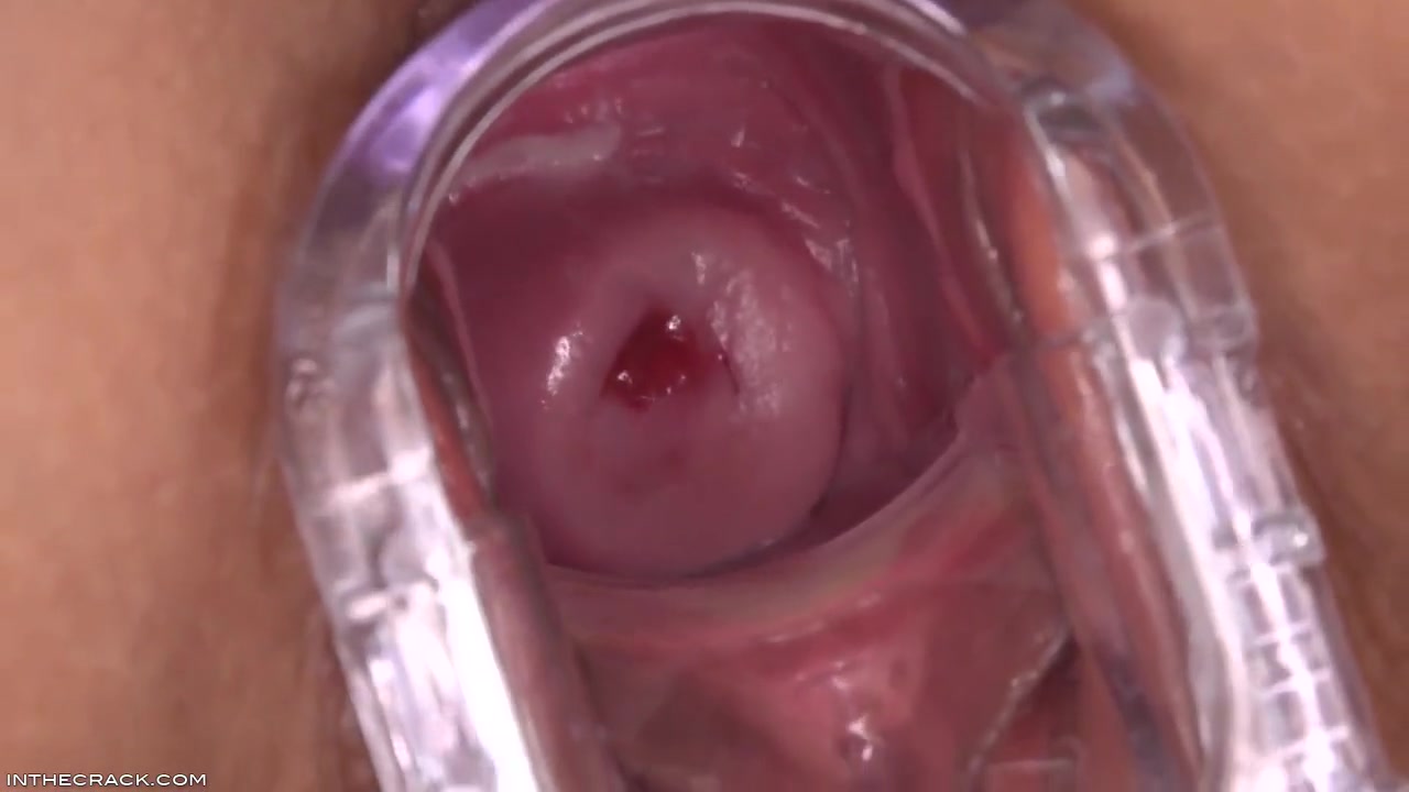Puckered Up Cervix