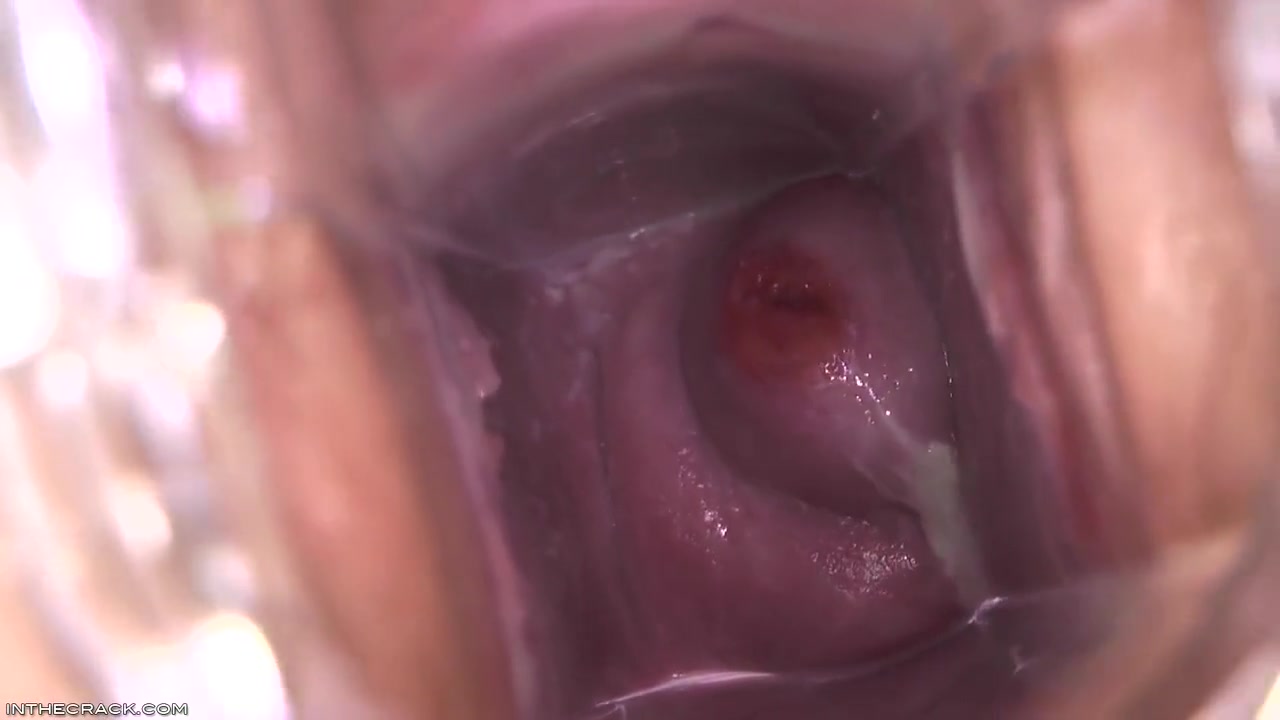 Cervix Cum Glob
