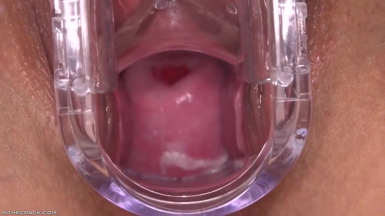 Puckered Up Cervix