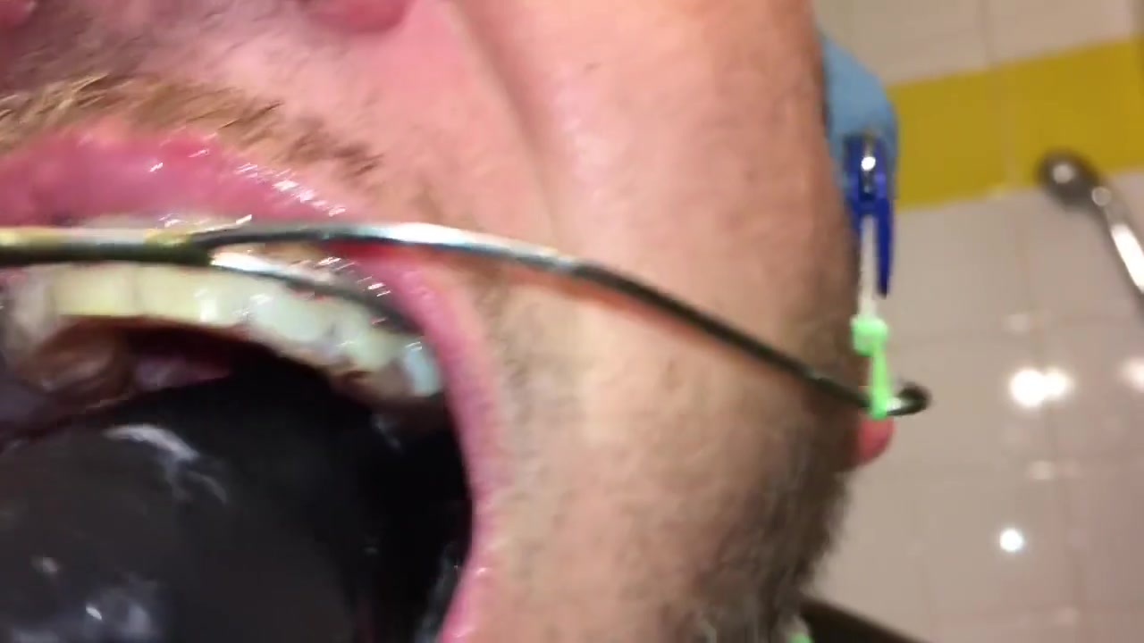 Horny Deepthroat Full Of Spit With Braces And Double Headgear