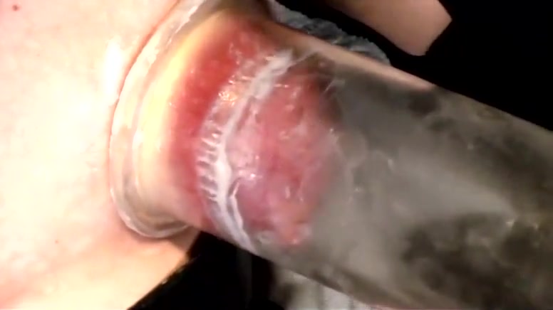 Breast Inflation and Smoking 20m