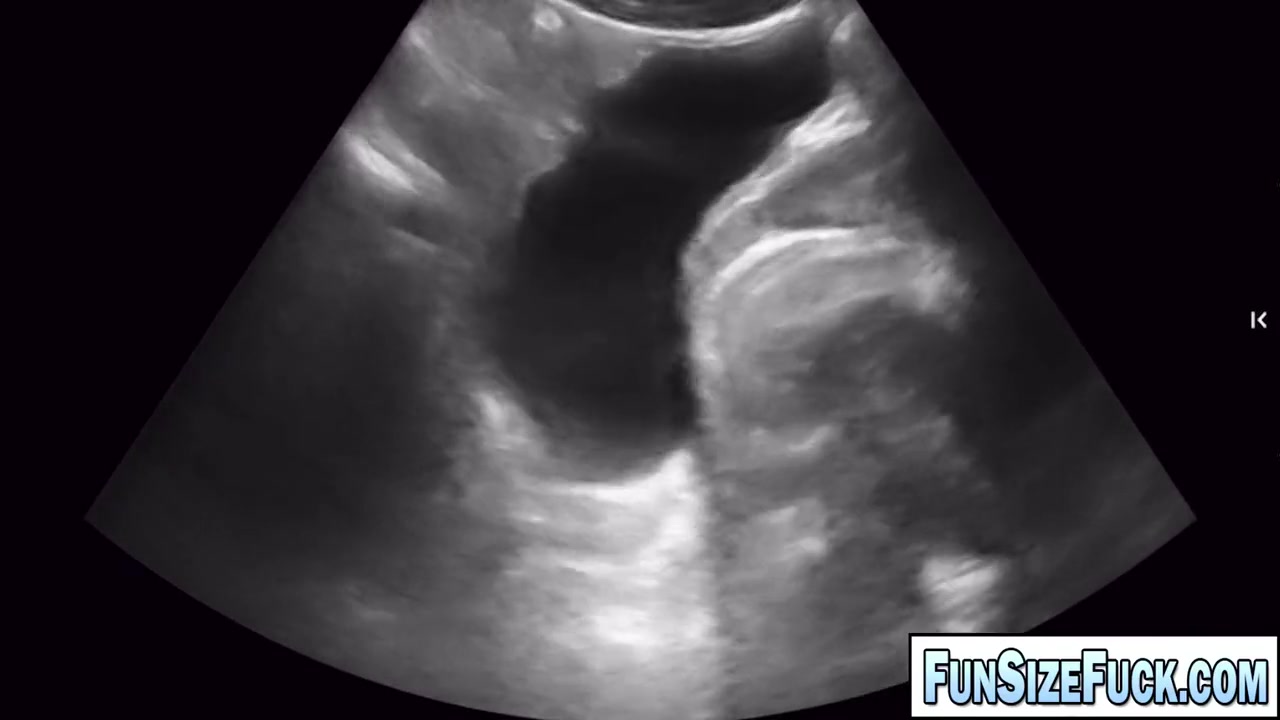 Ultra Scan Revealed A Huge Secret Hidden In His Belly Examination Of His Colon By Turned Out To Be An Experience He Would Never Forget! - Grayson Cole And Legrand Wolf