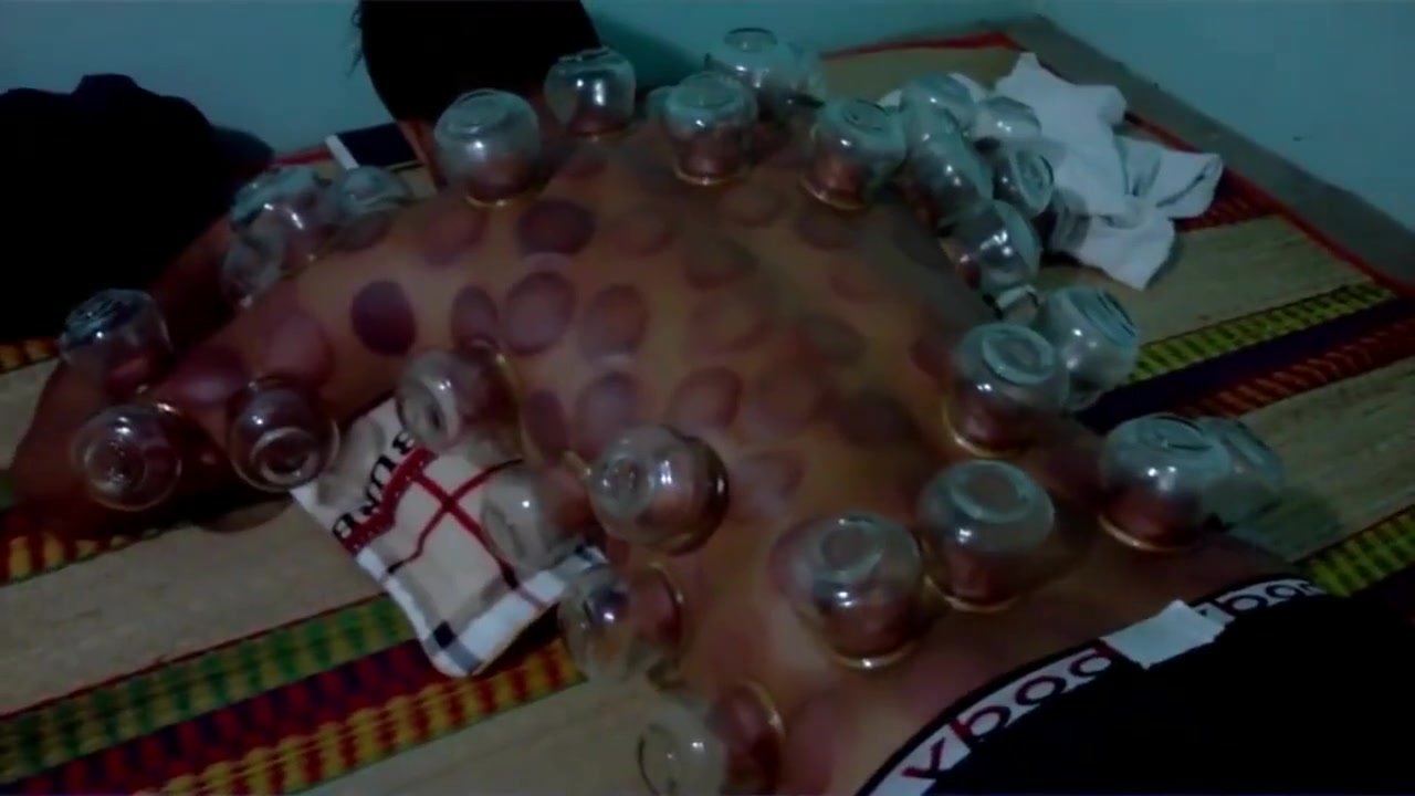 Massage - Cupping