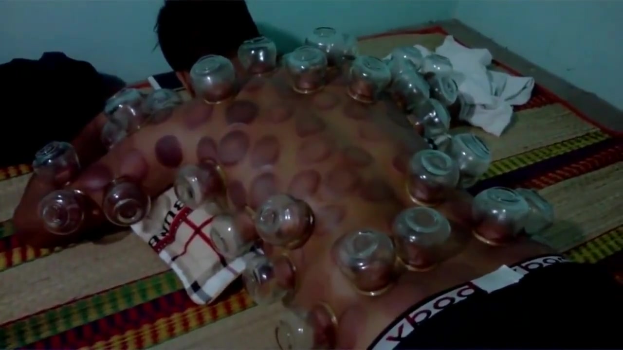 Massage - Cupping